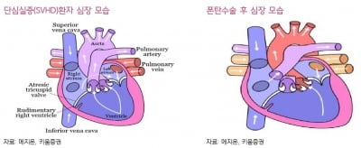 [종목+]메지온, 폰탄수술 치료제 가시화…가치제고 기대