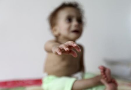 © Reuters. A malnourished boy cries in his home in Sanaa