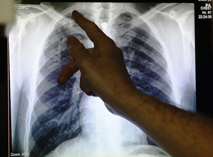 © Reuters. Clinical lead Doctor Al Story points to an x-ray showing a pair of lungs infected with TB (tuberculosis) during an interview with Reuters  on board the mobile X-ray unit screening for TB in Ladbroke Grove in London