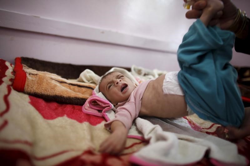 © Reuters. يونيسيف: 2.2 مليون طفل يمني يعانون من سوء التغذية الحاد
