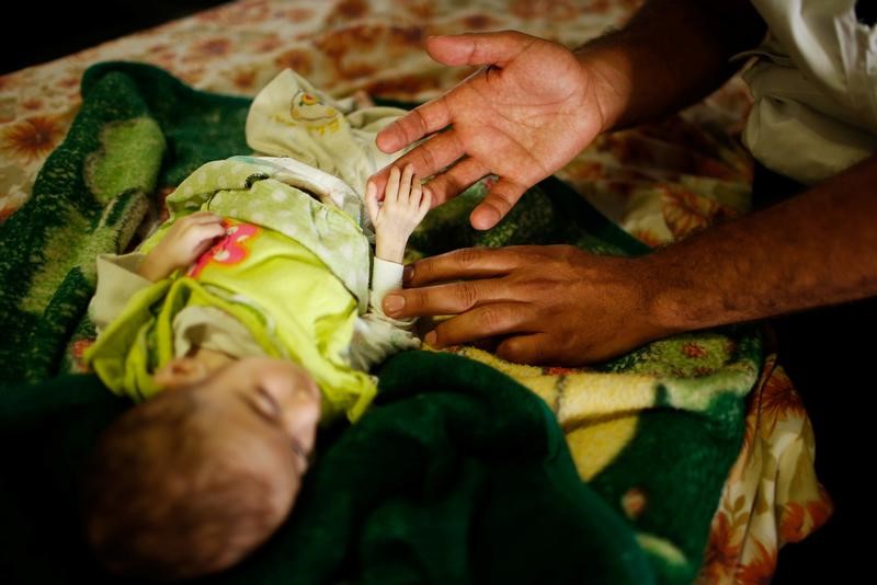 © Reuters. الجوع ينال من الأطفال الرضع مع استمرار الحرب في الموصل