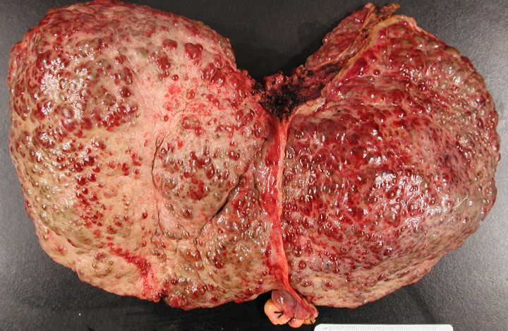 © Reuters. A human liver afflicted with Non-alcoholic Steatohepatitis, or NASH, that has progressed to cirrhosis, is pictured in this handout photo