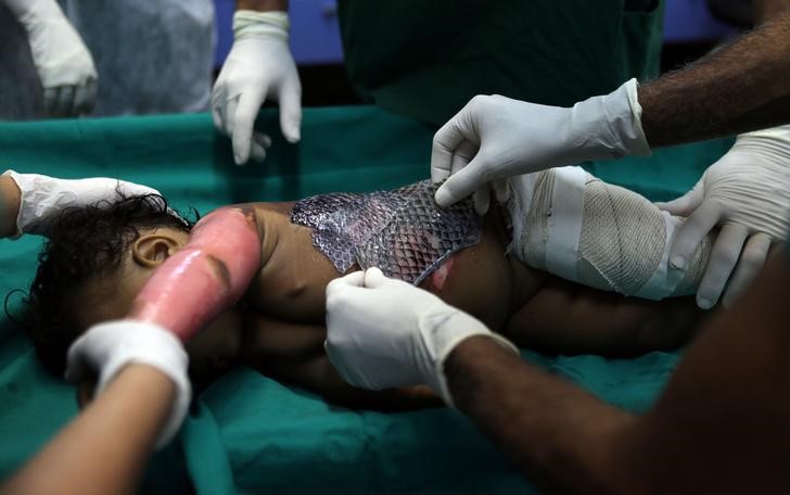 © Reuters. Médicos usam pele de tilápia para tratar queimadura de criança em Fortaleza