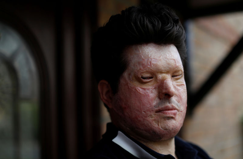 © Reuters. Acid attack victim Andreas Christopheros, poses for a photograph in his home in Truro