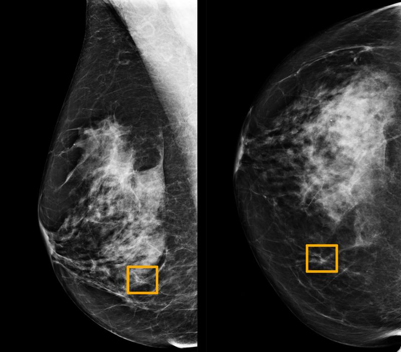 © Reuters. A yellow box indicates where an artificial intelligence (AI) system found cancer hiding inside breast tissue