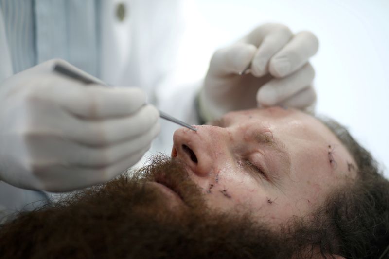 &copy; Reuters. FILE PHOTO: Plastic surgeon Dr. Joe Baroud, who offers his services for free to people injured by a massive explosion at the port area, removes stitches from the face of Shady Rizk in Beirut