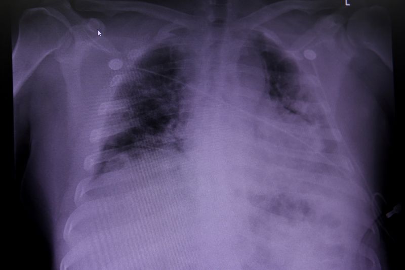 &copy; Reuters. 新型コロナ死者の肺に重度の損傷、症状「長期化」の原因か＝研究