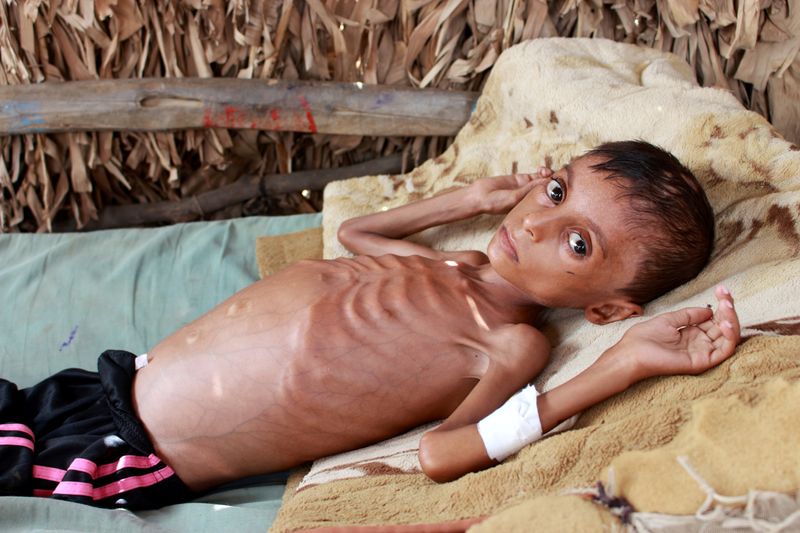 © Reuters. FILE PHOTO: Yemeni boy fights malnutrition as hunger stalks nation's children