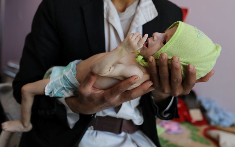 © Reuters. Child malnutrition at record highs in parts of Yemen -U.N. survey