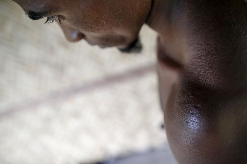 © Reuters. A victim of forced labor displays the scars on his shoulder during a Reuters interview in a village at Buthidaung township in northern Rakhine state