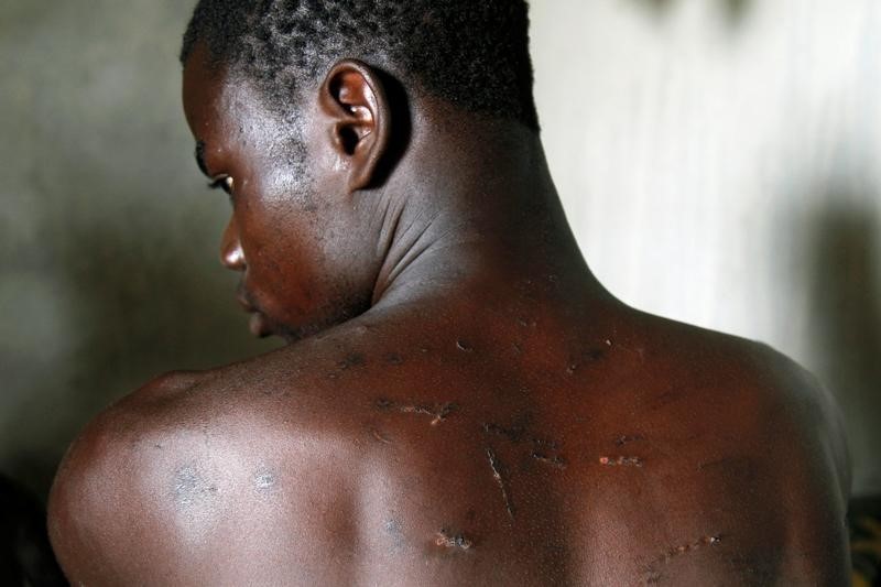 © Reuters. Zongo Meda shows his wounded back after being beaten by someone he said was an agent of SODEFOR in Guiglo