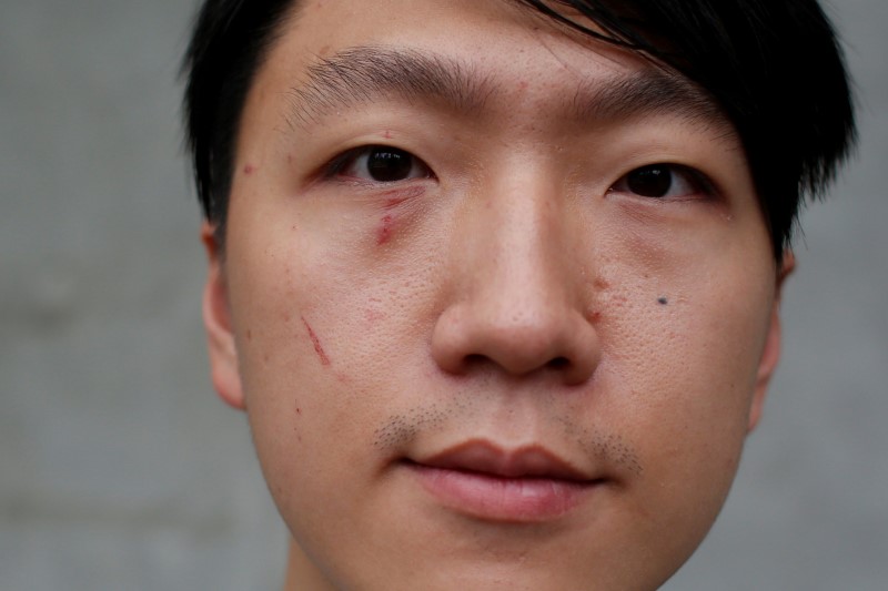 © Reuters. Injury is seen on the face of Edward Leung, a de facto leader of Hong Kong's independence movement, in Hong Kong