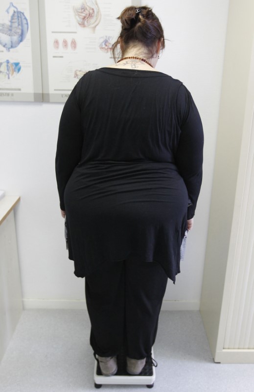 © Reuters. دراسة: جراحة إنقاص الوزن مرتبطة بزيادة معدلات الطلاق والزواج