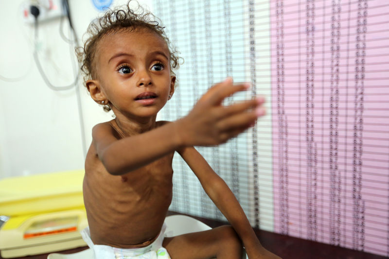© Reuters. Malnourished Ferial Elias, 2, gestures as she is being weighed at a malnutrition treatment ward at al-Thawra hospital in Hodeidah