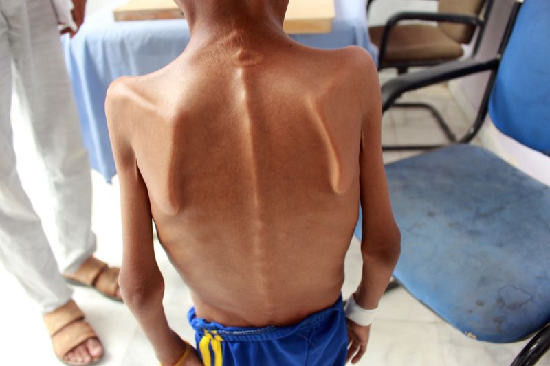 &copy; Reuters. أطفال اليمن يتضورون جوعا وشبح المجاعة يلوح في الأفق من جديد